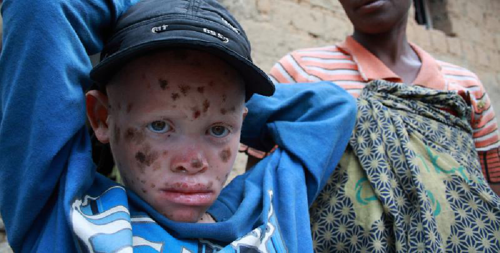 Albinismia sairastava nuori poika Ephreim sinisessä paidassa ja lippalakissa